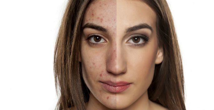 acne treatment Orange CA