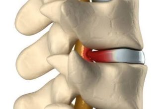 Consult a Top Neuro Spine Surgeon in Kolkata for Disc Replacement Surgery in India
